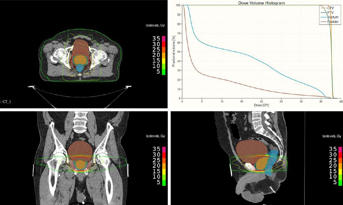A radiotherapy plan for a patient with prostate cancer showing the clinical target volume, which includes the prostate (orange), bladder (brown), rectum (blue) on the axial (top left), coronal (bottom left), and sagittal (bottom right) plane with isodose levels as well as the corresponding dose volume histogram (DVH) (top right).
