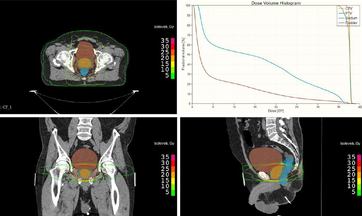  A radiotherapy plan for a patient with prostate cancer showing the clinical target volume, which includes the prostate (orange), bladder (brown), rectum (blue) on the axial (top left), coronal (bottom left), and sagittal (bottom right) plane with isodose levels as well as the corresponding dose volume histogram (DVH) (top right).